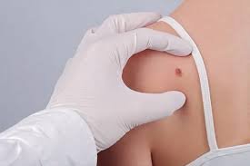 Mohs Surgery