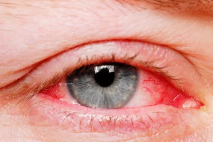 Red Eyes