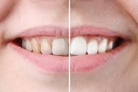 Teeth Whitening